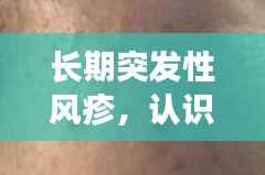长期突发性风疹,认识、预防与治疗全攻略
